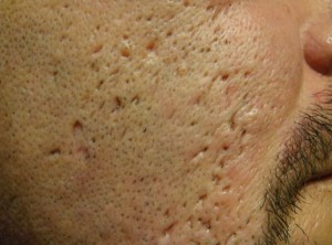 comment-enlever-les-cicatrices-d'acné